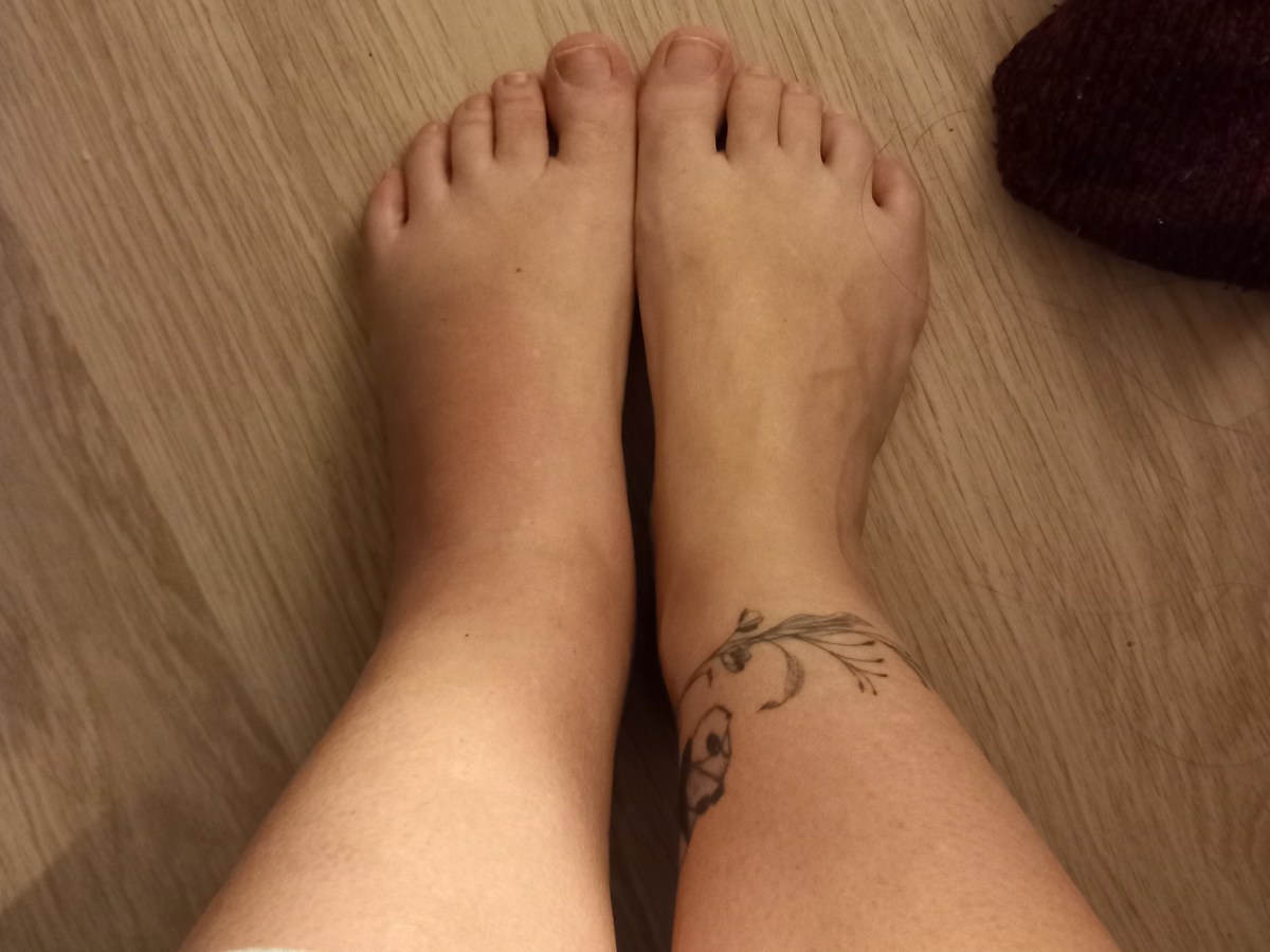 Même mes entorses sont compliquées&nbsp;!